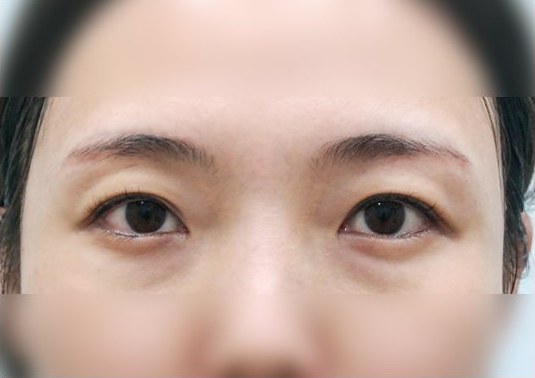 전후사진 1 — 수술 전 눈(사진 속 '수술 전' 표기)