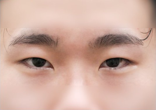 전후사진 2 — 수술 전 눈(사진 속 '수술 전' 표기)