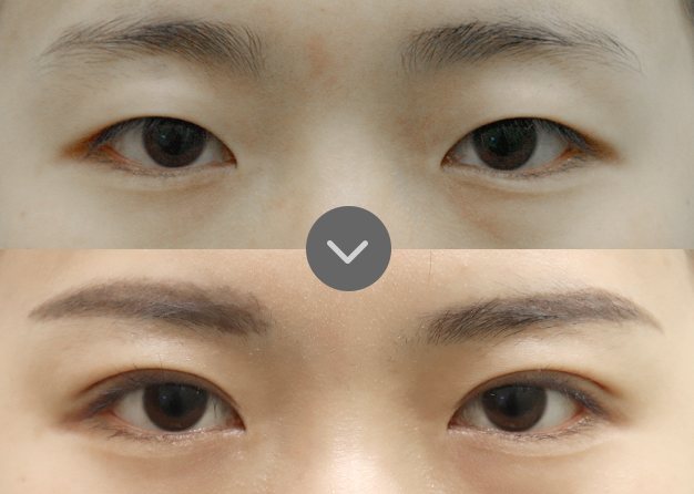 사례 02 쌍꺼풀 재수술 전(위)·후(아래) 눈 사진