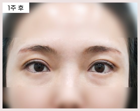 전후사진 1 — 수술 1주 후 눈(사진 속 '1주 후' 표기)