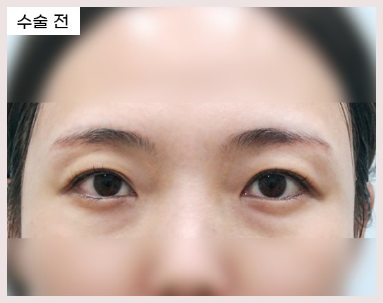 전후사진 1 — 수술 전 눈(사진 속 '수술 전' 표기)