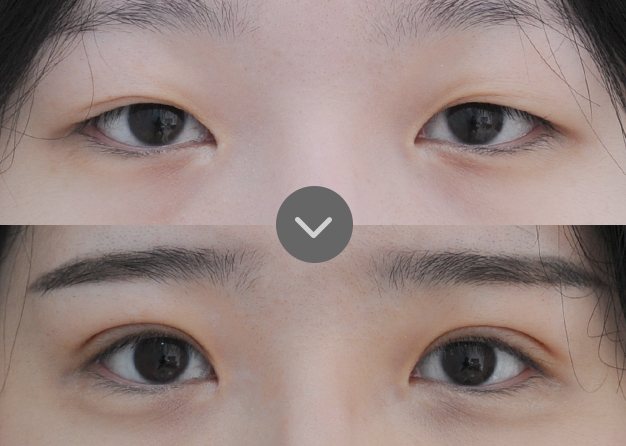 사례 01 쌍꺼풀 재수술 전(위)·후(아래) 눈 사진