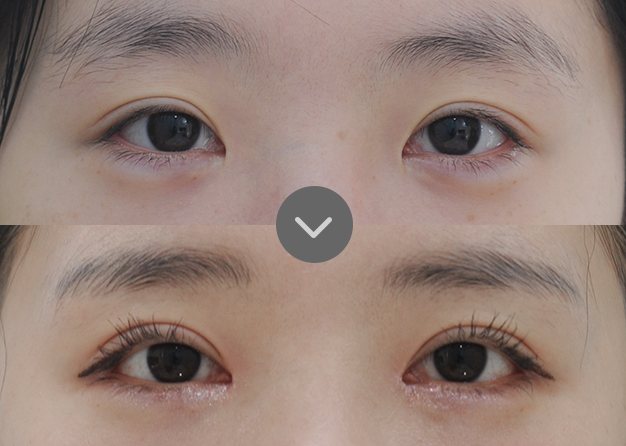 사례 04 쌍꺼풀 재수술 전(위)·후(아래) 눈 사진